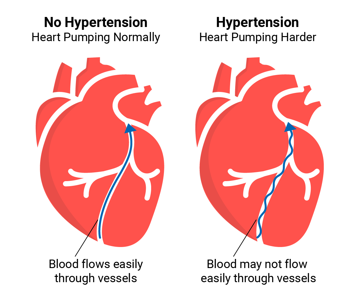 Hypertension Treatment in Ghaziabad